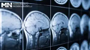 Brain scan report showing traumatic brain injury